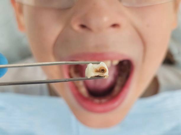 Best Emergency Tooth Extraction in Ashland, NE